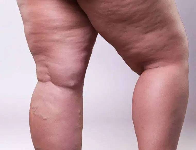 uma mulher com bastante gordura nas pernas