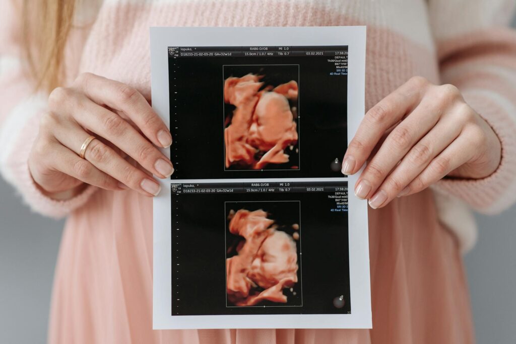 a imagem mostra uma mulher com o resultado de um ultrassom